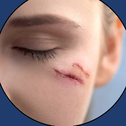 Facial scar revision