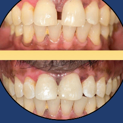Smile Designing
