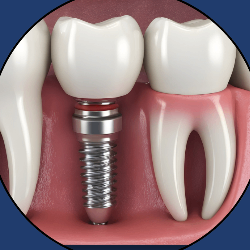 Dental Implants